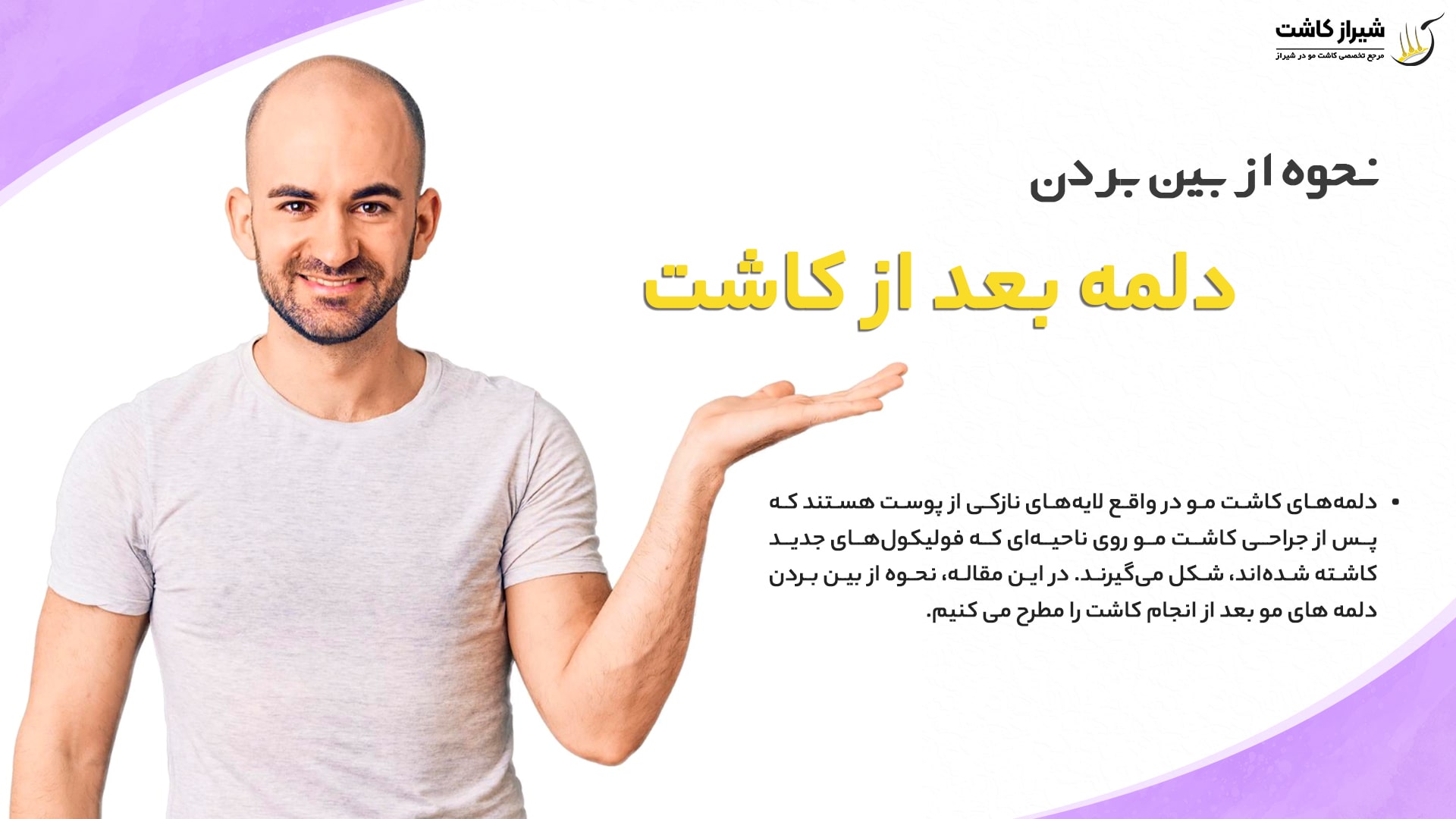 کیست مویی بعد از کاشت مو